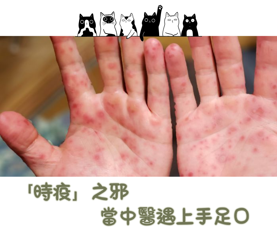 中醫如何看手足口病？成年人病情更重？結合『清熱利濕』縮短病程、預防重症