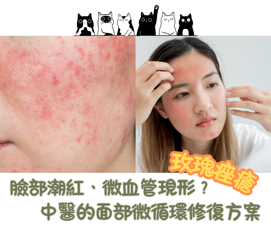 臉部潮紅、微血管現形？解析「玫瑰痤瘡」：為何狂搽消炎膏反而更紅？中醫的面部微循環修復方案