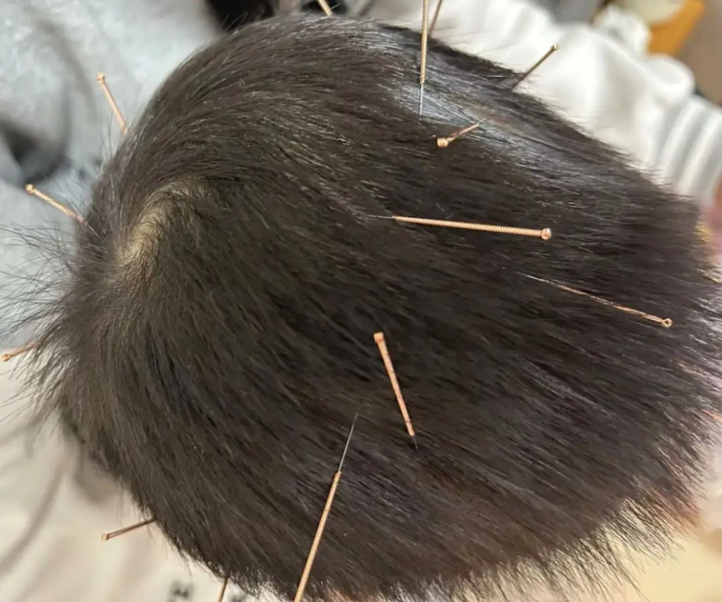 小兒頭皮針